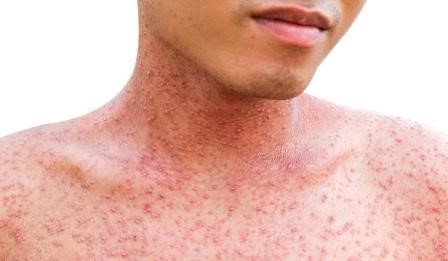 В соседнем с Оренбуржьем регионе выявлено более 100 случаев заболевания корью