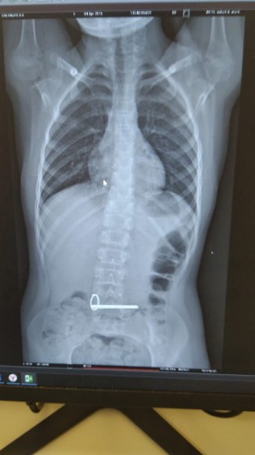 В Оренбуржье врачи извлекли из желудка 8-летнего ребенка связку ключей