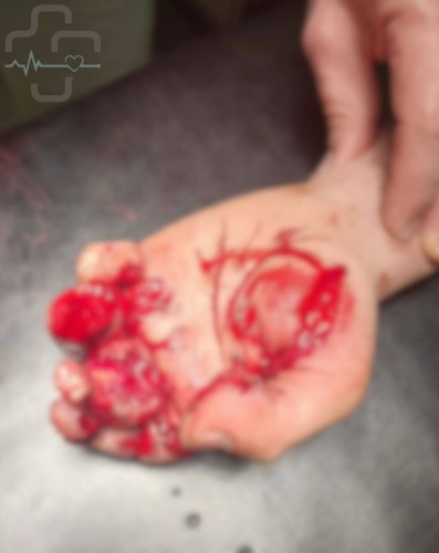 В Орске подросток потерял палец из-за взрыва петарды В Орске подросток потерял палец из-за взрыва петарды