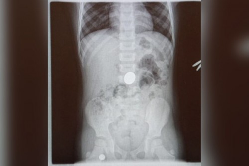 В Бузулуке 2-летняя девочка проглотила монету